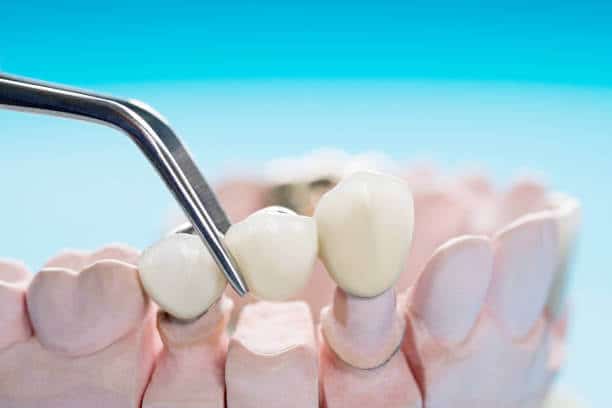 Problems with Dental Bridges: What Rock Hill Patients Should Watch For