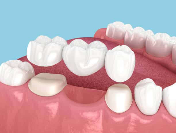 Who Is a Candidate for Dental Bridges in Rock Hill, SC? Dentist’s Guide