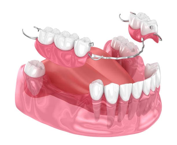 Dental Bridges vs. Partial Dentures in Rock Hill, SC: Which Is Right for You?