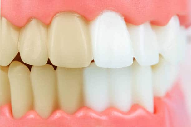Common Causes of Tooth Discoloration Explained by Rock Hill Dentists
