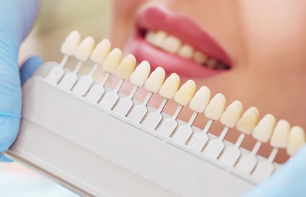 Porcelain Veneers Pros and Cons in Rock Hill: What to Expect Before You Commit